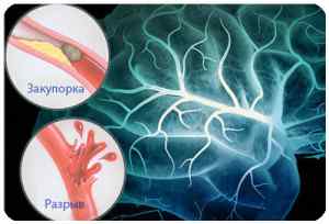 Нарушение мозгового кровообращения