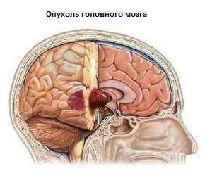 При злокачественном образовании