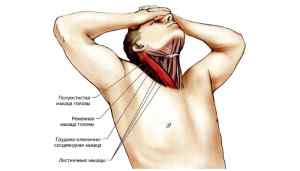 Синдром лестничной мышцы
