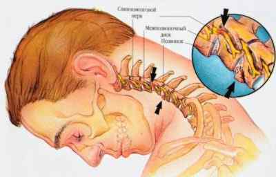 Боль из-за шейного отдела позвоночника